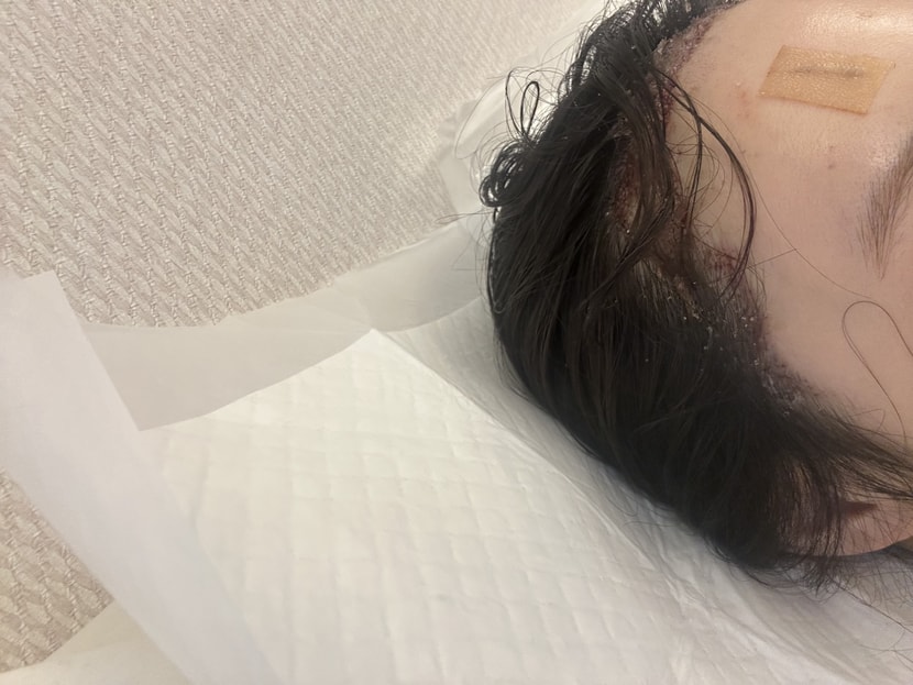 1. 오늘 모발이식 했는데 이식부위에 앞머리 붙은거 떼도 될까요??