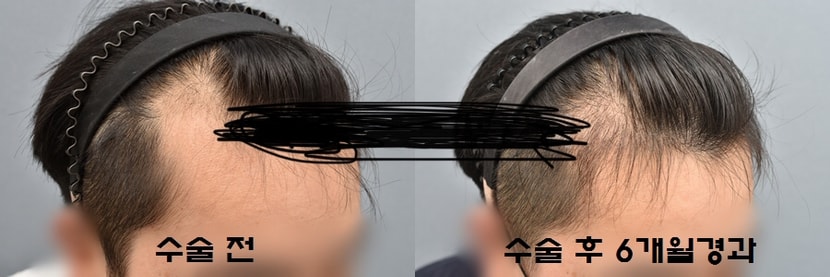 수술 후 6개월