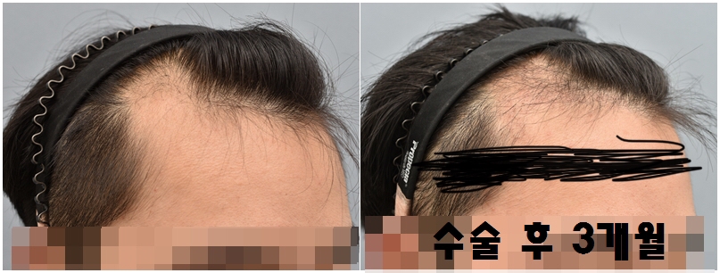 수술 후 3개월