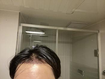 4060모 모발이식 3일차