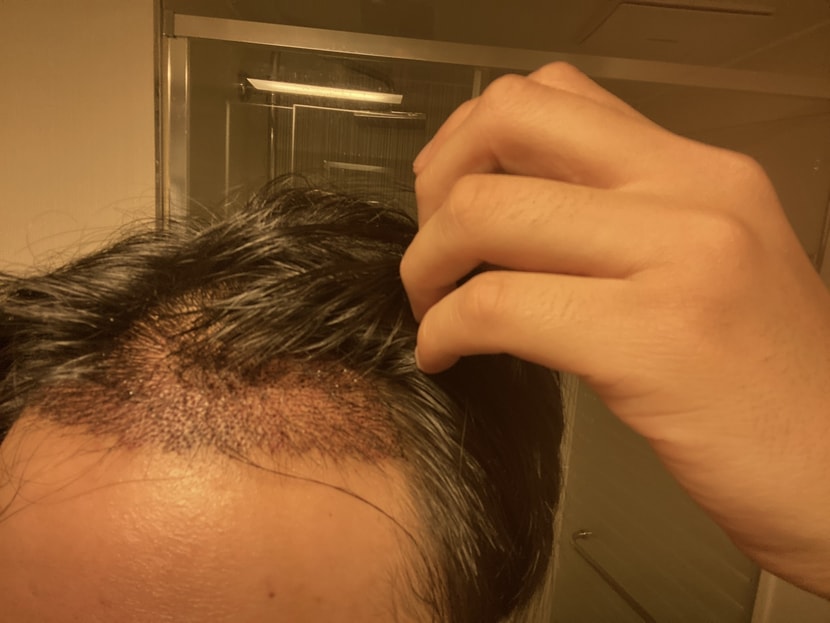 4060모 모발이식 3일차