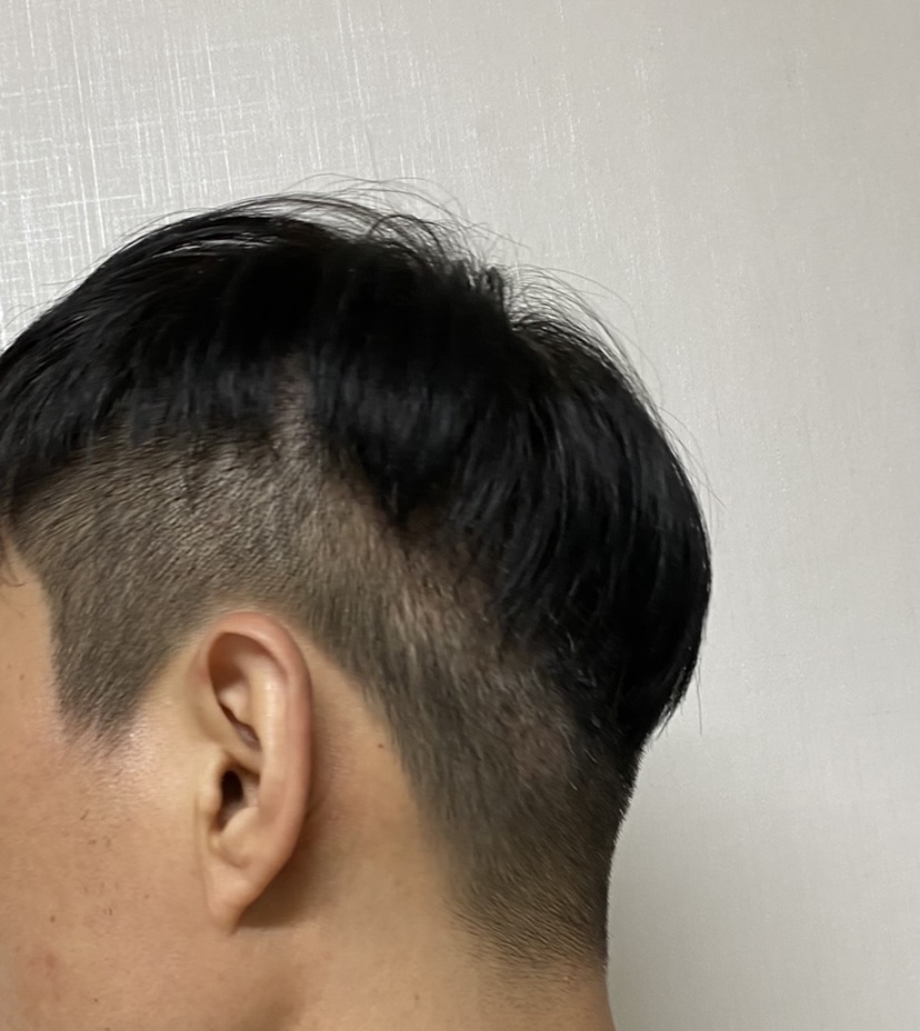 수술후 좌측