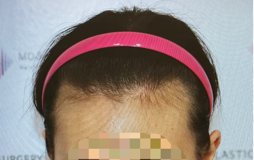 모발이식 전 정면 헤어라인