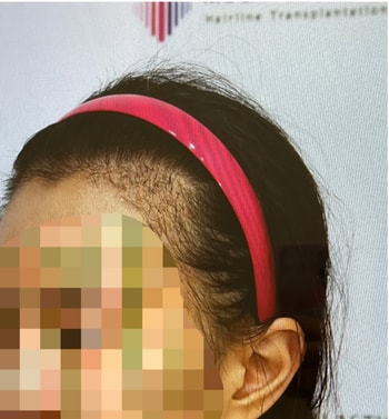 모발이식 4주차 측면 헤어라인