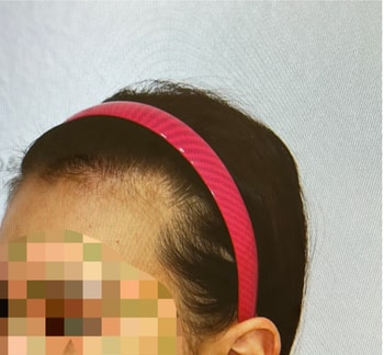 모발이식 전 측면 헤어라인