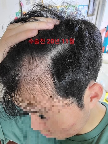 수술전 좌
