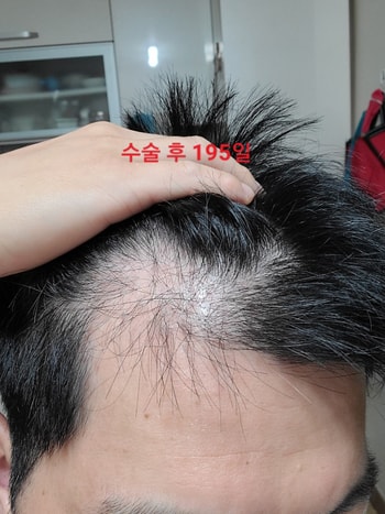 현재 7개월 경과