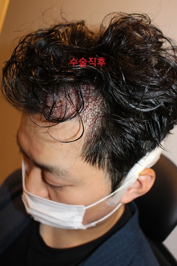 수술 직 후 좌