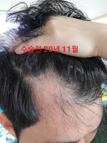 수술 전 우 측