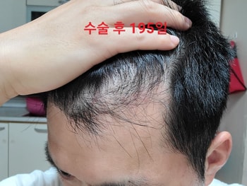 현재 7개월 경과 