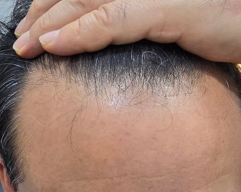 모발이식 수술 앞두고 있습니다.