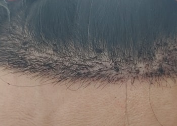 헤어라인