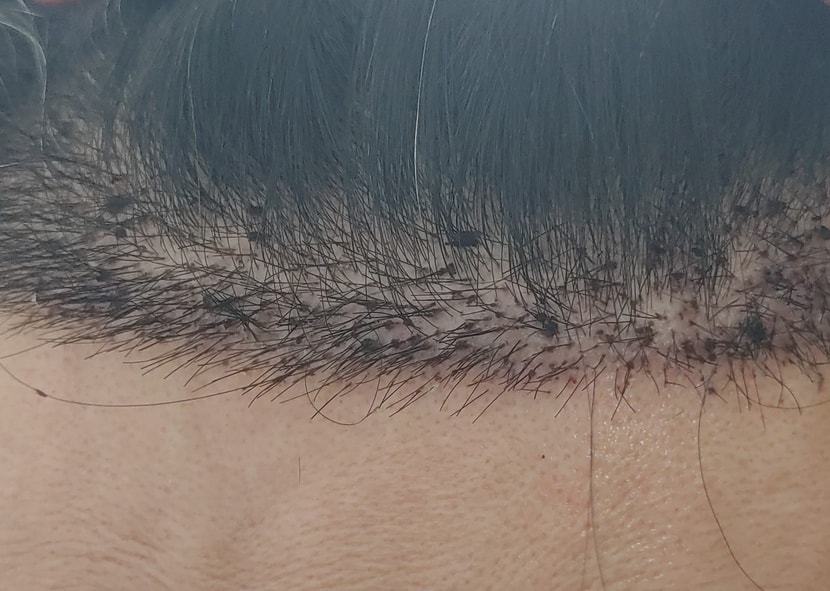 헤어라인