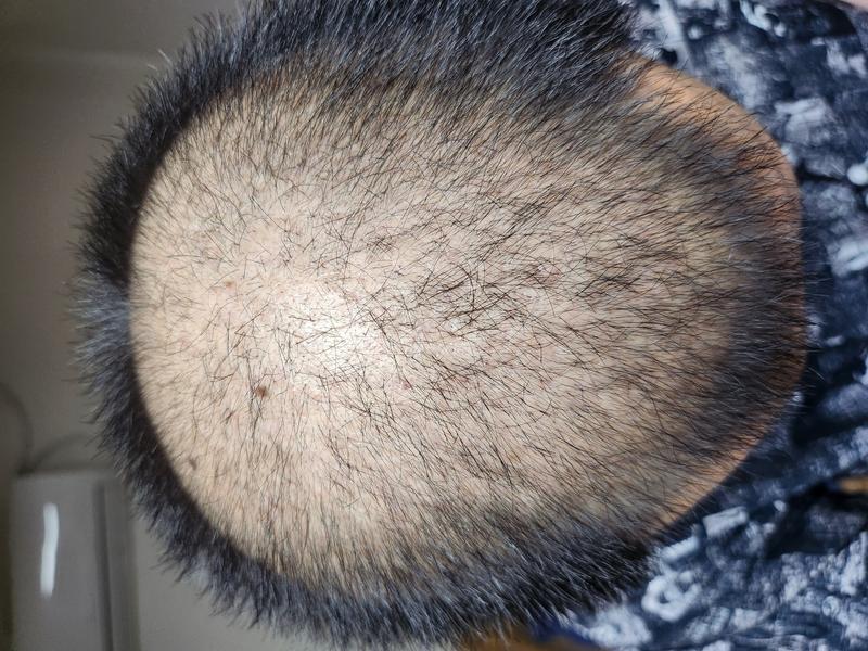 頭頂部植毛5500毛 31日目の一ヶ月体験談です。