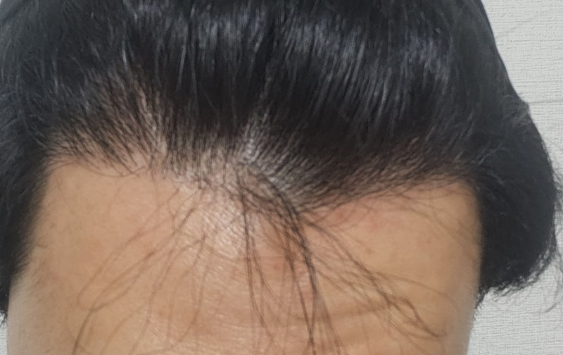 모발이식 실패일까요?