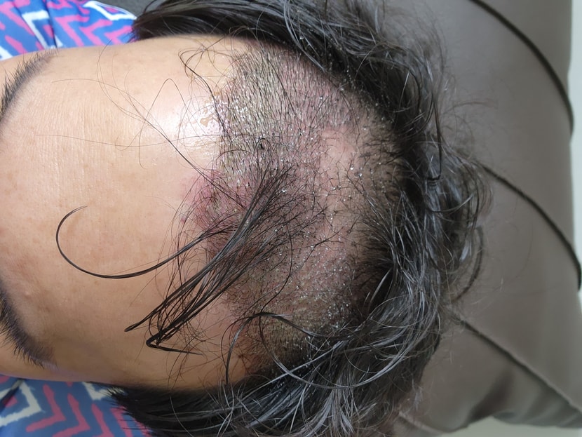 수술이틀째 입니다