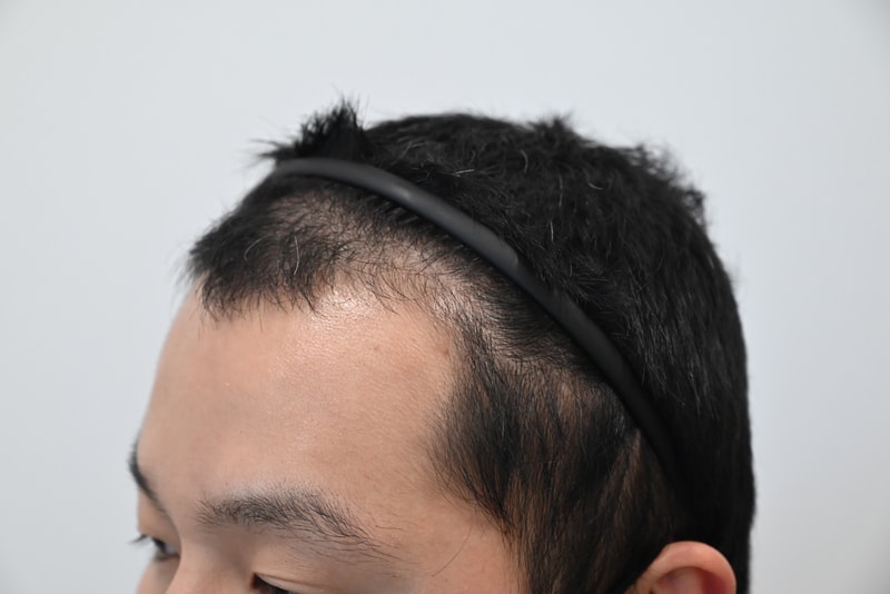 Review of 2,000 Hair Transplantation