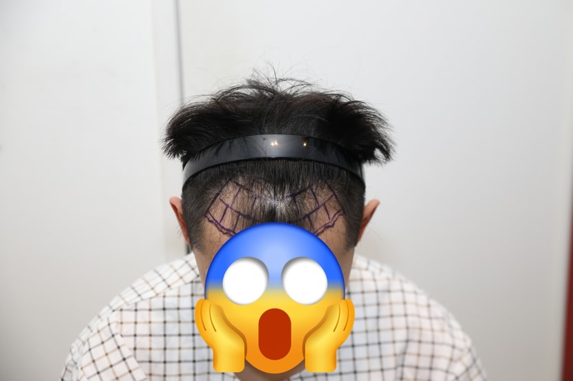 수술전 M자 극심한 상태