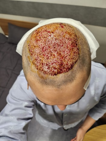 수술직후 찍은사진