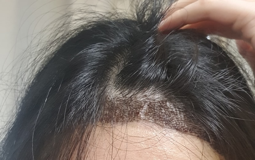 땜빵이 생겼어요