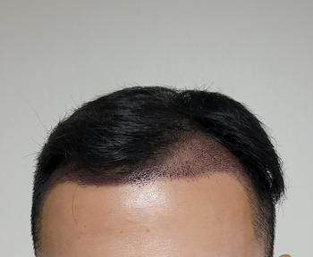 이식 정면사진