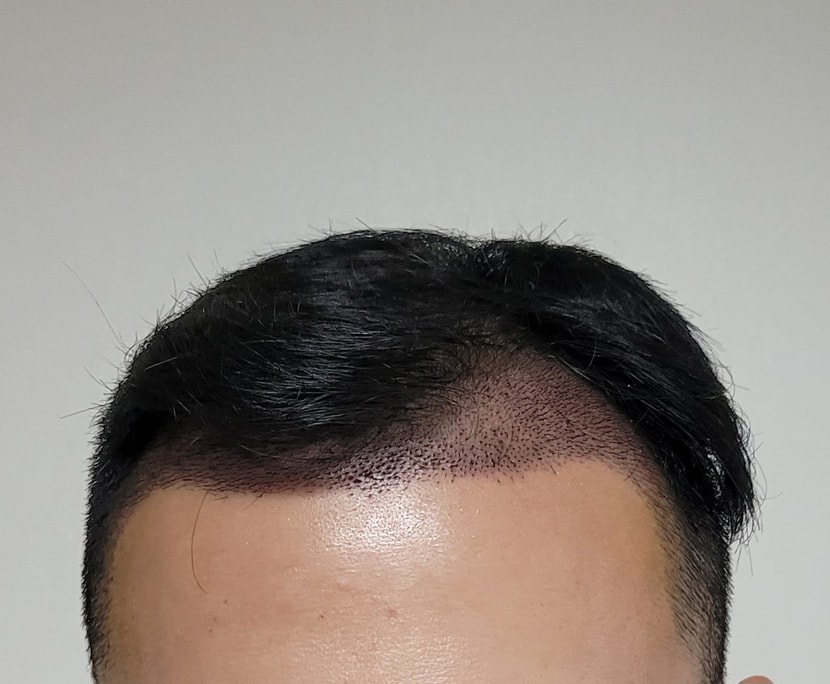 이식 정면사진