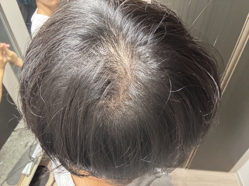모발이식