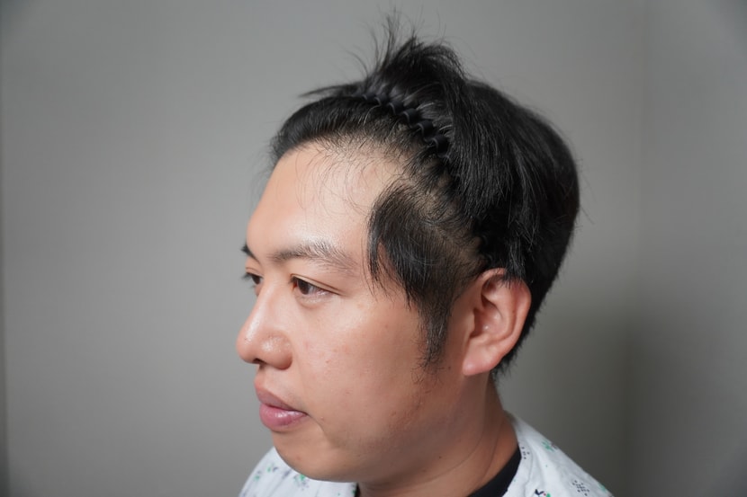 시술 전 비어있는 M자