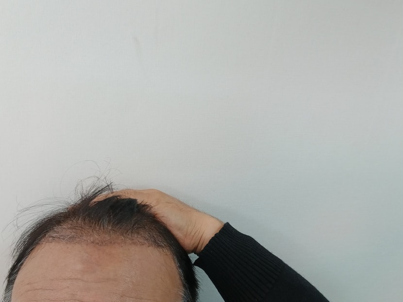 모발이식 한달차