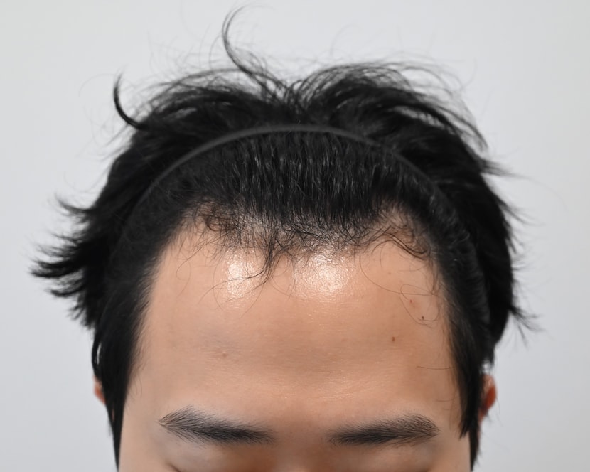 수술전