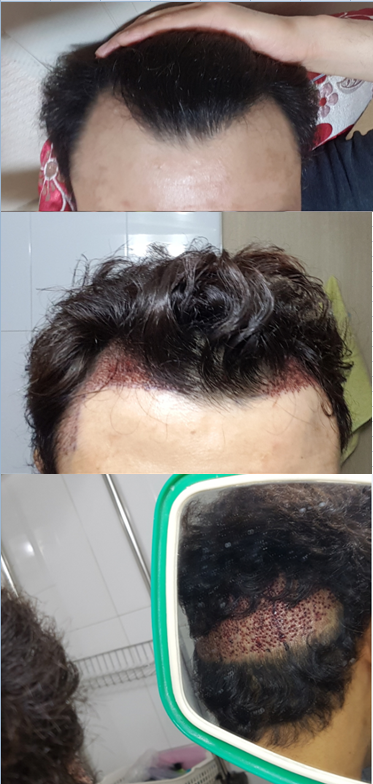 비절개 작업 했습니다~