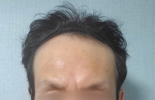 수술하기 전 사진