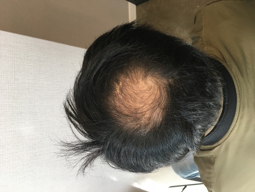 수술 전