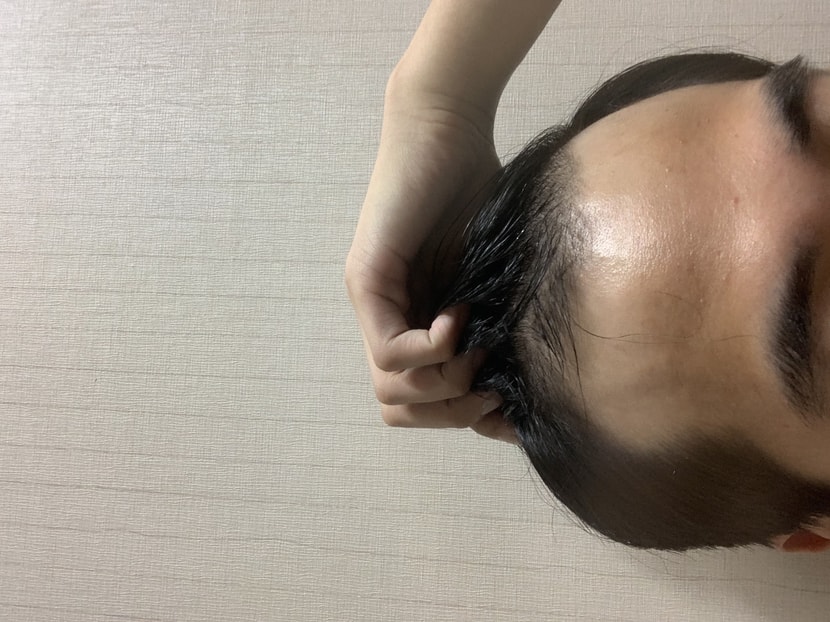 이식전