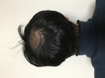수술 후