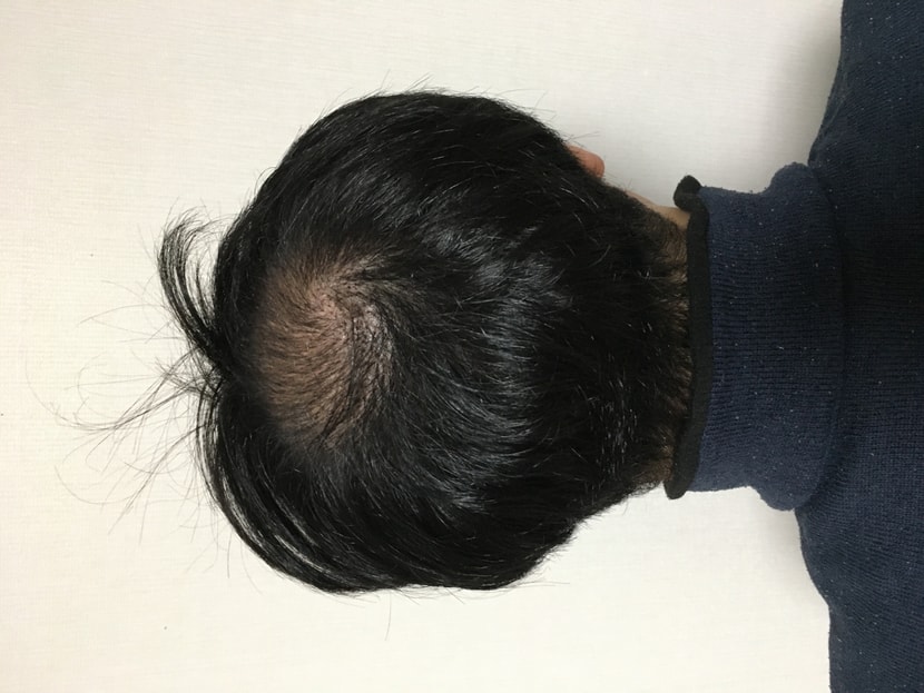 수술 후