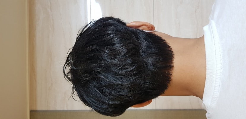수술 후 뒷머리