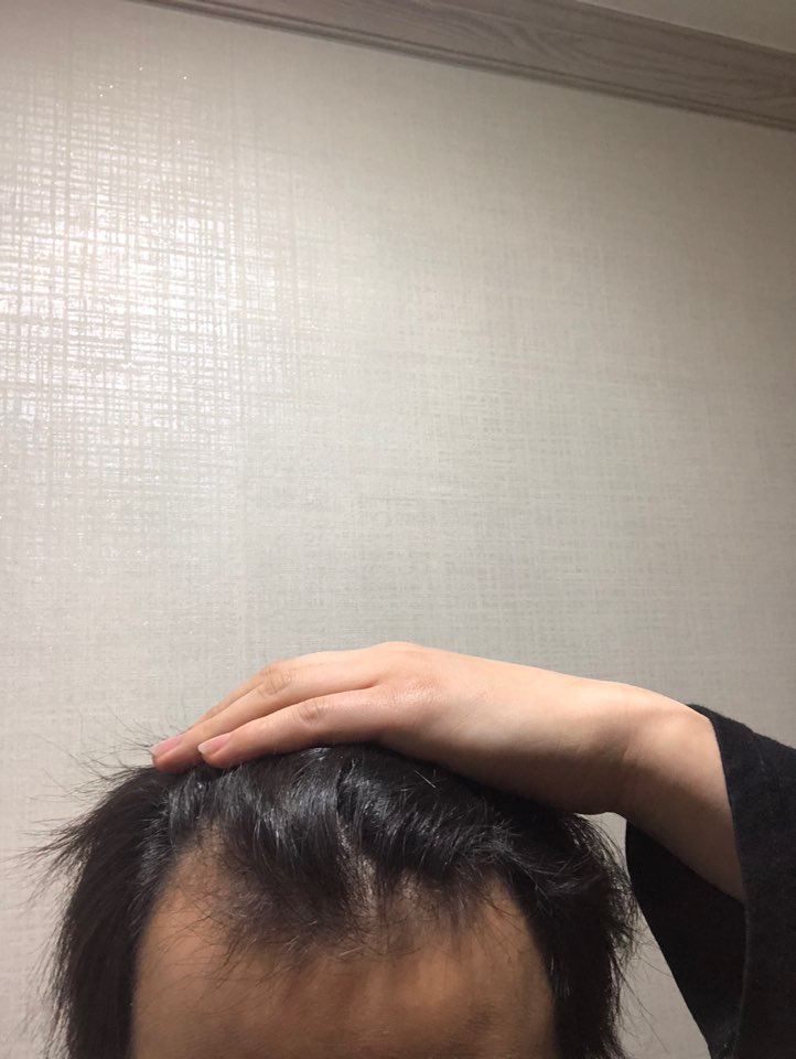 이식전
