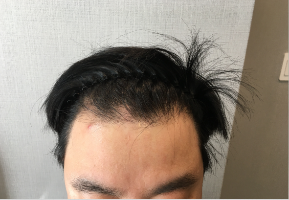 수술 전
