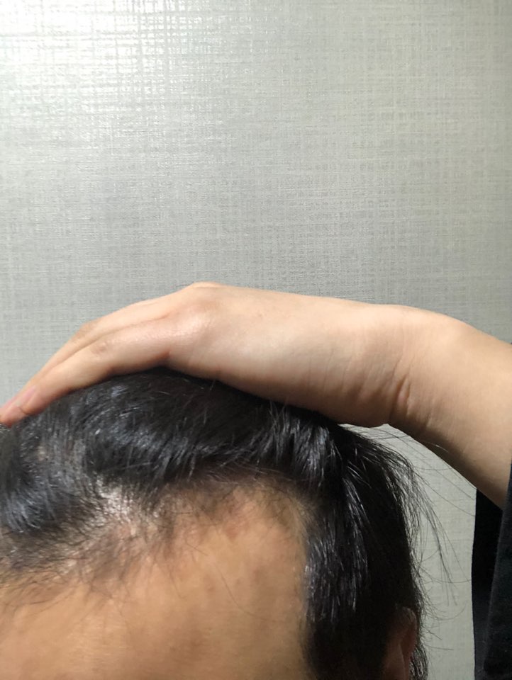 이식전