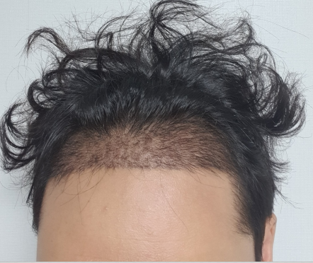 수술 후