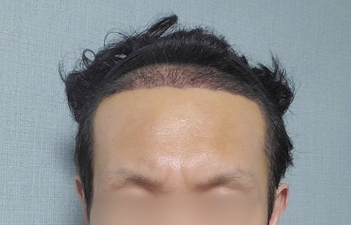 수술 후 사진