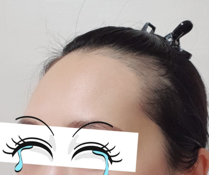 모발이식 전