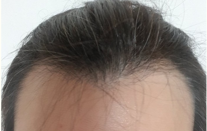 수술 전
