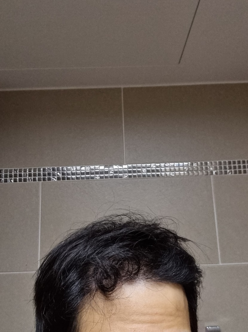 이식후