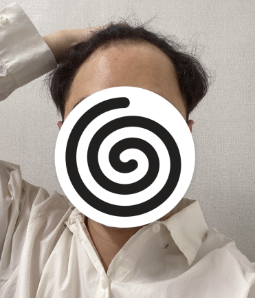 이식 전