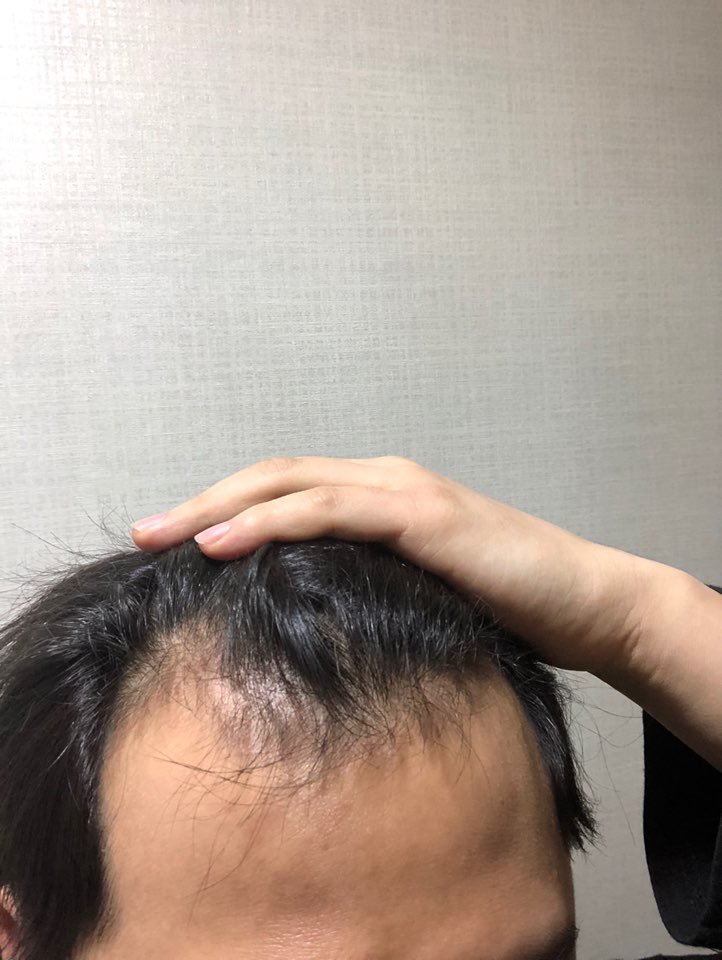 이식전