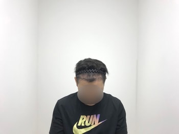 &lt;수술 8개월 후&gt;
