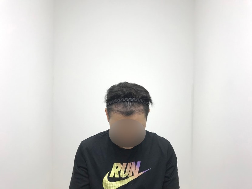 &lt;수술 8개월 후&gt;