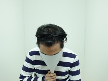 &lt;수술 1년 2개월 후&gt;